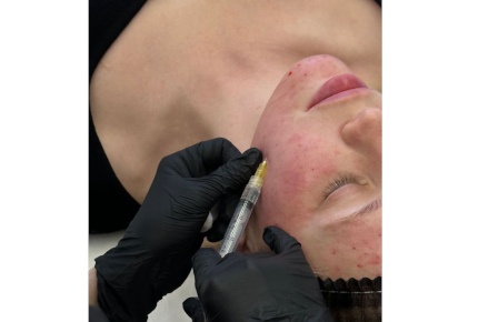 Плазмолифтинг со скидкой 50% от салона Diamond