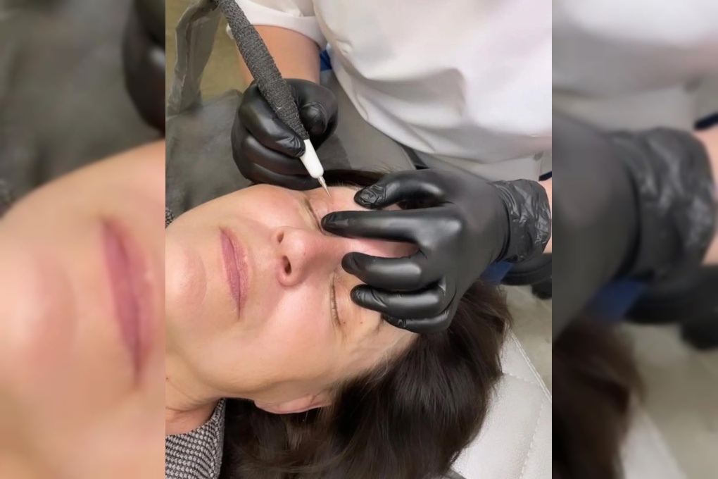 Удаление папиллом и шипиц электрокоагулятором со скидкрй 50% в студии Irina Berlova cosmetology