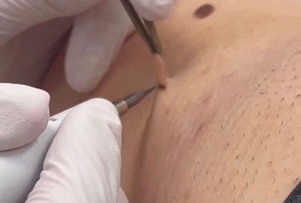 Удаление папиллом и шипиц электрокоагулятором со скидкрй 50% в студии Irina Berlova cosmetology